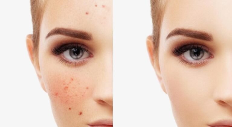 The Quick Way to Reduce Pimples Naturally